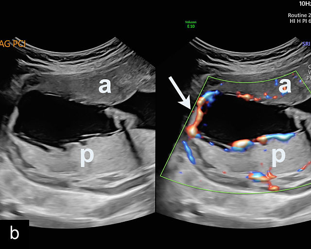Ultrasound Evaluation Of The Placenta Umbilical Cord And Membranes ultrasound-evaluation-of-the-placenta-umbilical-cord-and-membranes